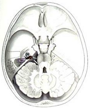 ANtumorIntracanalicular.jpg (26159 bytes)