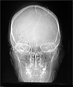 after-skull-shunt.jpg (12883 bytes)