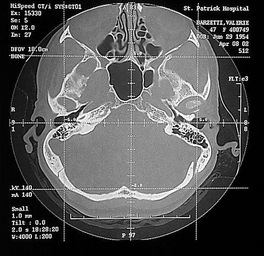 beforeCTmastoid.jpg (69846 bytes)