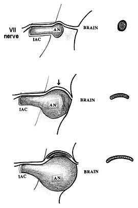 nerve_fraying.jpg (16840 bytes)