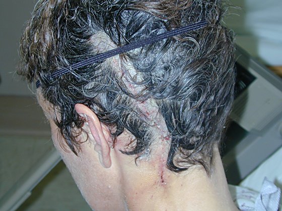 Scalp on Scalp Stitches